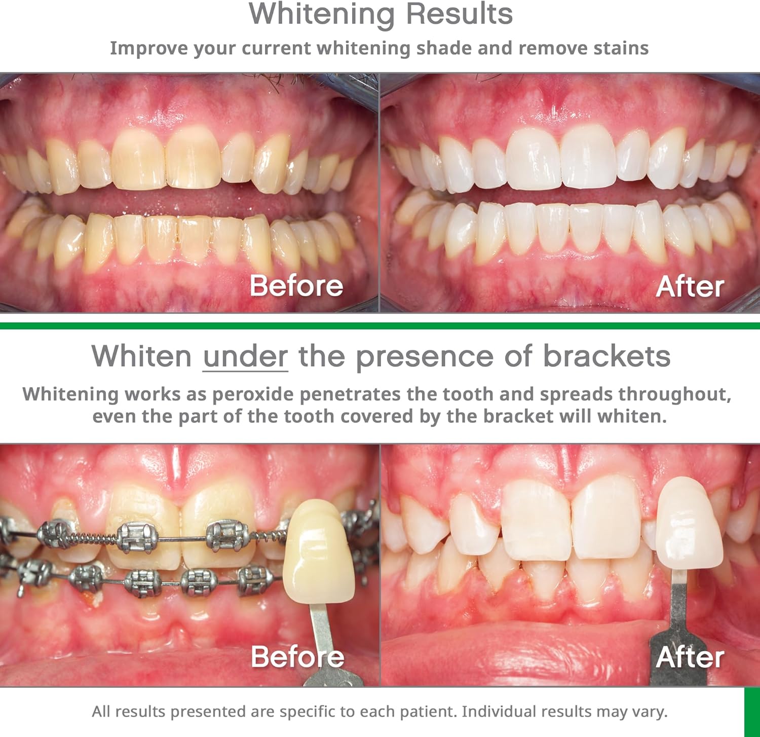 Opalescence Whitening Bundle