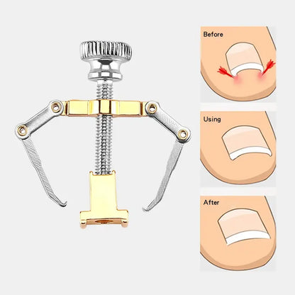Pedicure Pro Ingrown Nail Corrector