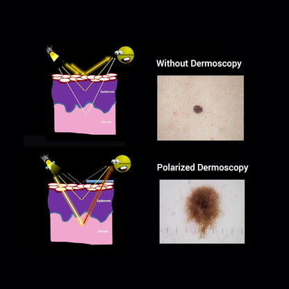 IBOOLO DE-3100 Dermatoscope 