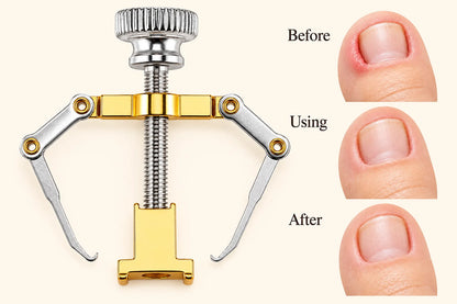 Pedicure Pro Ingrown Nail Corrector 