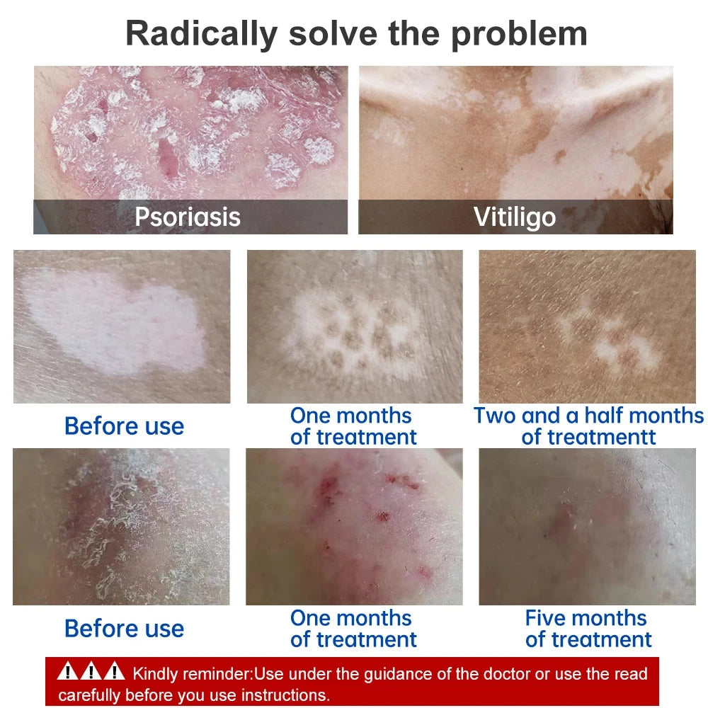 Lamp for Vitiligo