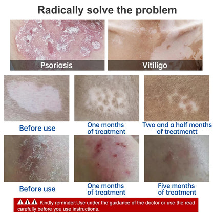 Lamp for Vitiligo